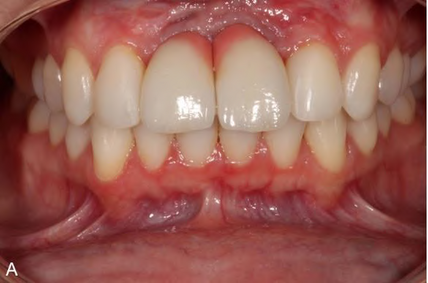 Same patient without the gingival epithesis