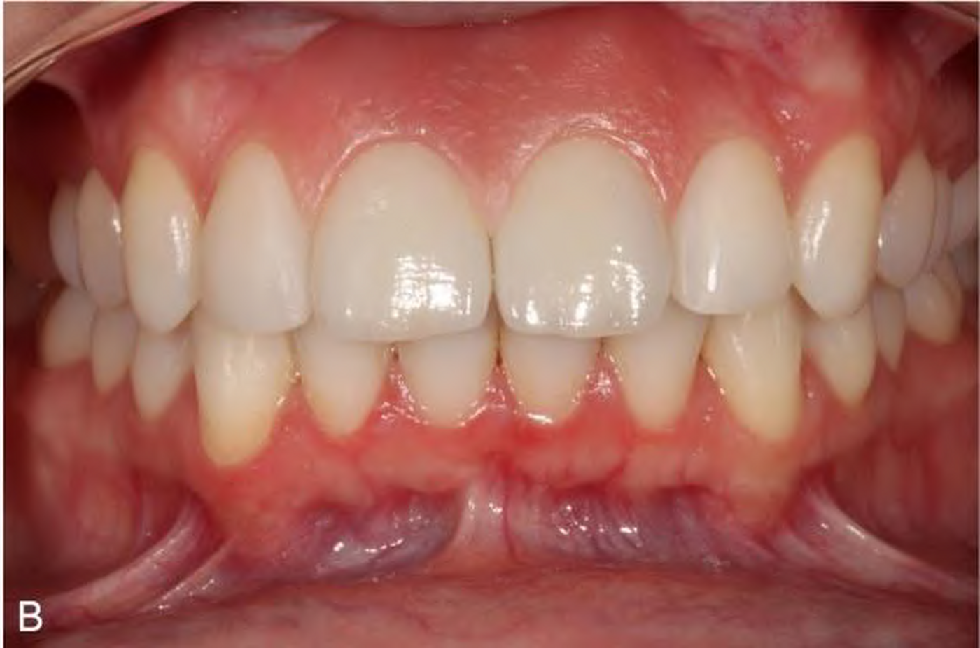 Patient wearing the documented gingival epithesis