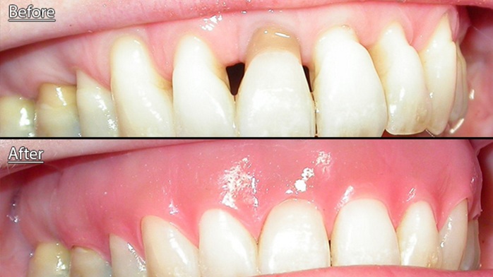 Patient wearing a gingival mask