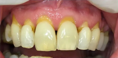 The same upper front teeth without the gingival epithesis