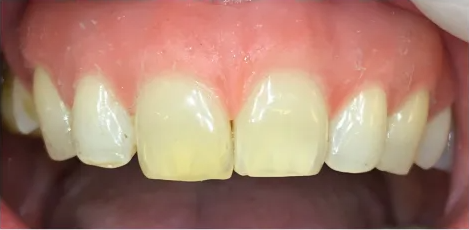 Upper front teeth with an e-Dentic gingival epithesis