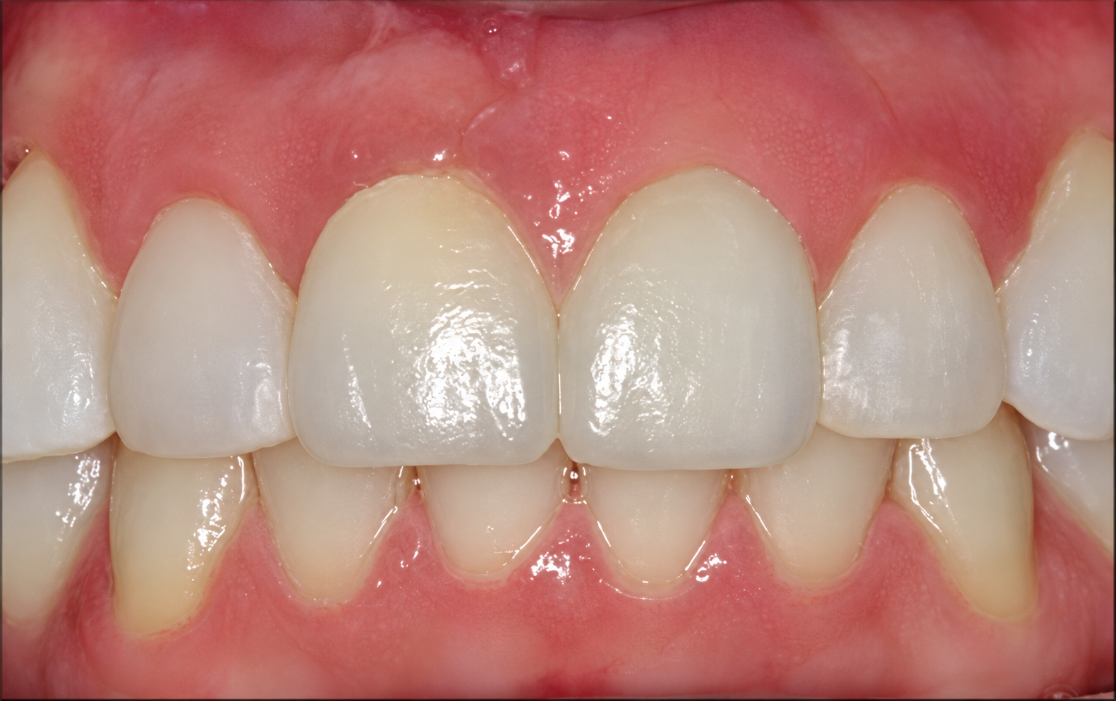 Enhanced clinical view with a gingival veneer covering recession associated with a malpositioned anterior implant